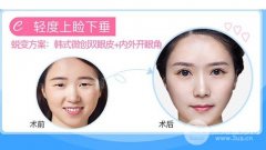 韩式微创双眼皮恢复图记录，“隐形”果超好!
