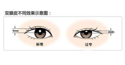 双眼皮手术修复医院