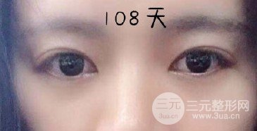 双眼皮手术修复医院