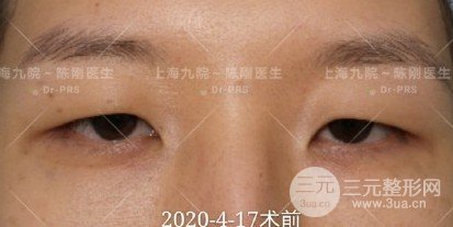 上眼皮松弛矫正术后恢复图片