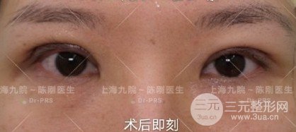上眼皮松弛矫正术后恢复图片