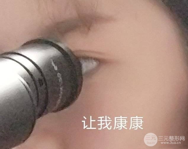 [科普]假体隆鼻的危害和后遗症的罪魁祸首竟然是ta?!|附真人案例