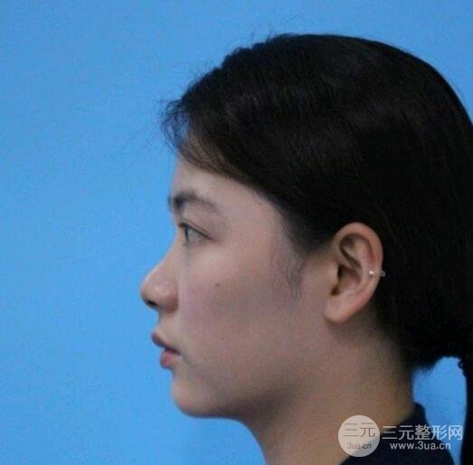 假体隆鼻真人案例