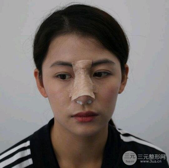 假体隆鼻真人案例