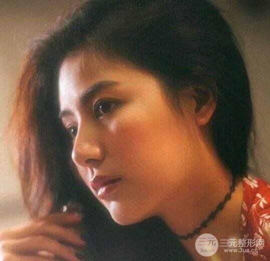 假体隆鼻真人案例