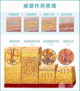 威塑抽脂恢复期长吗？想夏天穿清凉装，你得先了解这个