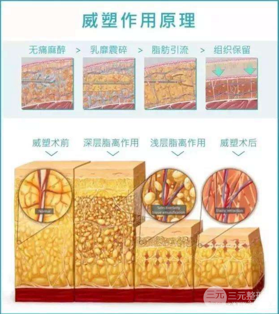 威塑抽脂恢复期