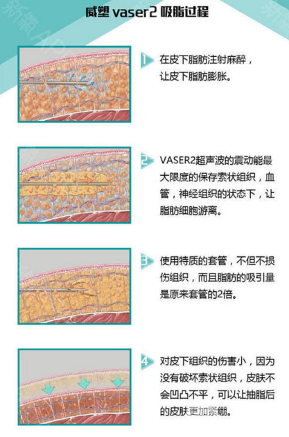 威塑抽脂恢复期