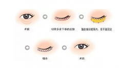 眼袋大成球，还不赶快做去眼袋手术，肯定觉得“香”