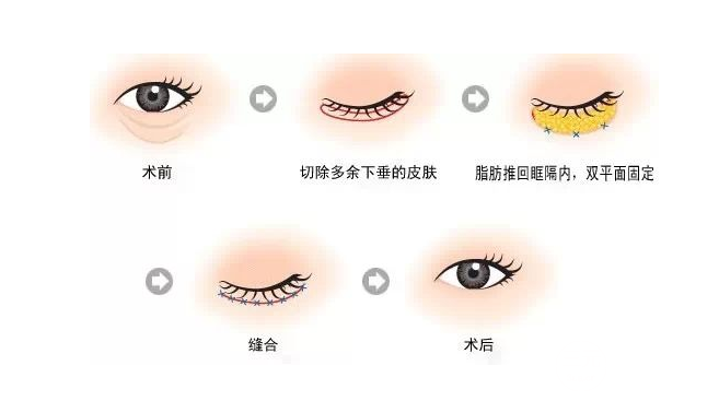 眼袋大成球,还不赶快做去眼袋手术,肯定觉得“香”
