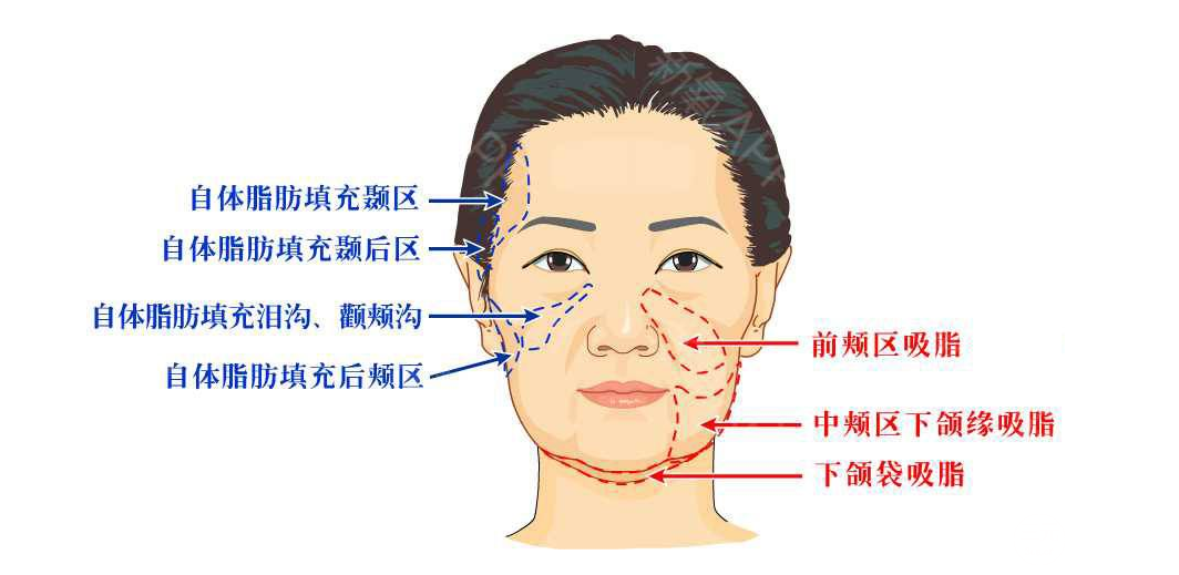 面部吸脂恢复期