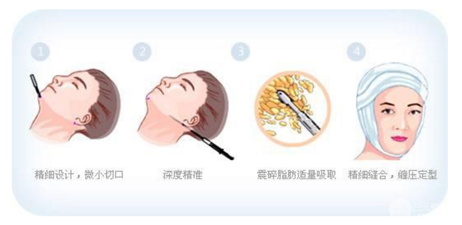 面部吸脂恢复期