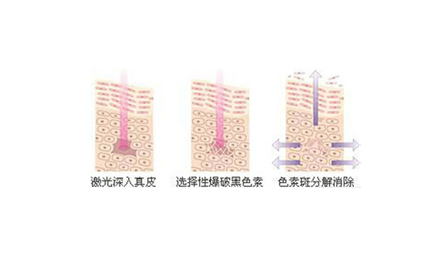 有名的白瓷娃娃激光据说做2次就能美白