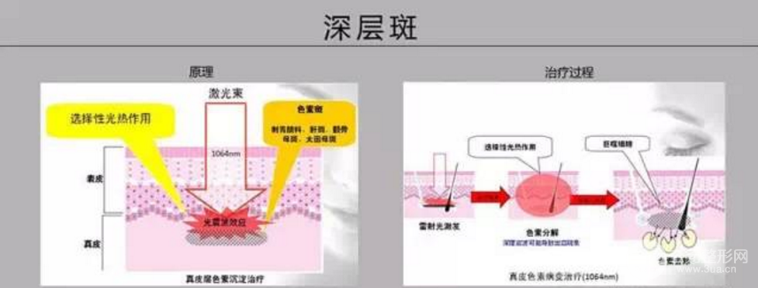 有名的白瓷娃娃激光据说做2次就能美白