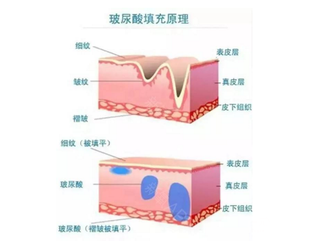 法令纹填充用什么品牌的玻尿酸好?