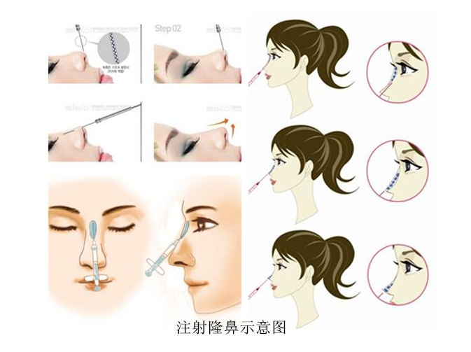 注射隆鼻的修复方法