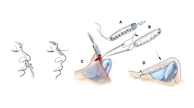 注射隆鼻的修复方法