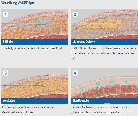 威塑抽脂有什么不同