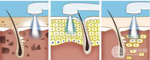 像素激光祛痘果怎么样