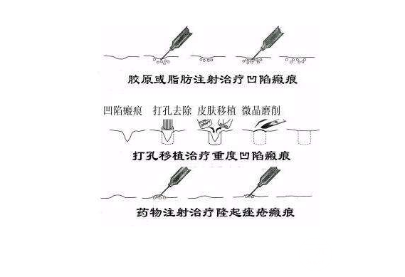 微晶磨削缓解痘痕的果