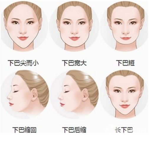 脂肪垫下巴能保持多长时间