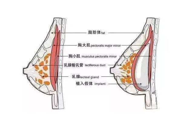 麦格娜绮丽假体解读