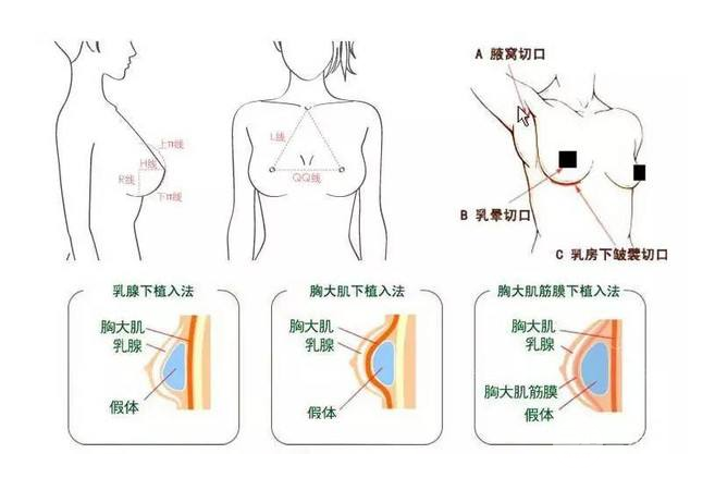 麦格娜绮丽假体解读