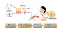 详细部自体脂肪填充多少钱？它让你的年龄“会撒谎”