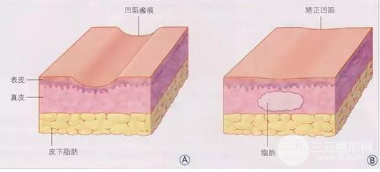 详细部自体脂肪填充多少钱