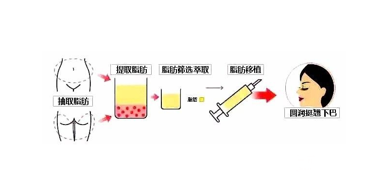 详细部自体脂肪填充多少钱
