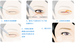 医生建议做外切去眼袋的原因！眼下脂肪太多就适合做这个