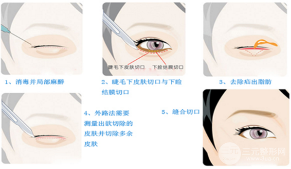 医生建议做外切去眼袋的原因！眼下脂肪太多就适合做这个