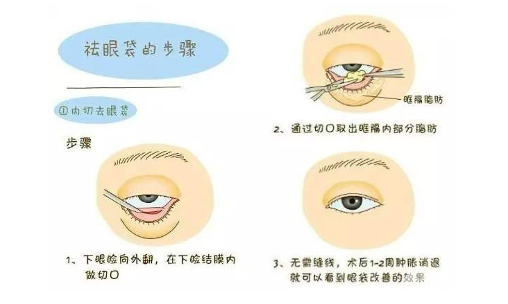 医生建议做外切去眼袋的原因！眼下脂肪太多就适合做这个