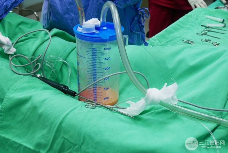 副乳吸脂后多久能看到果