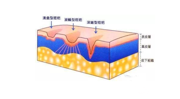 激光去黑头果怎么样？让美离你不远!