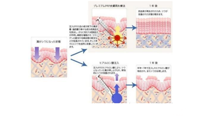激光去黑头果怎么样？让美离你不远!