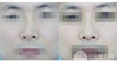 鼻骨矫正手术