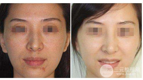 注射注射美白价格多少