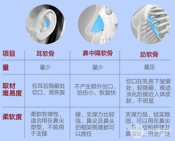 肋软骨做鼻子怎么样 软骨材料对比