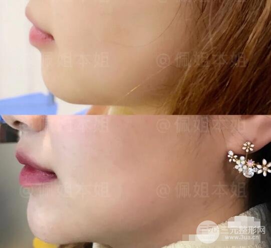 原生下巴 vs 玻尿酸下巴