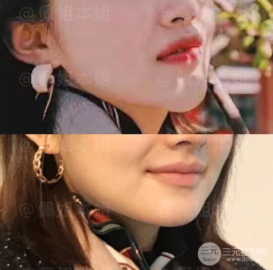 玻尿酸下巴(上) vs 舒铂下巴(下)