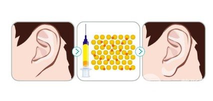 玻尿酸丰耳垂手术