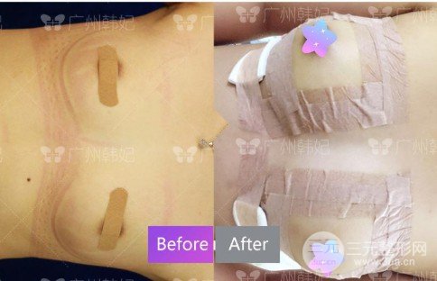 自体脂肪移植丰胸手术