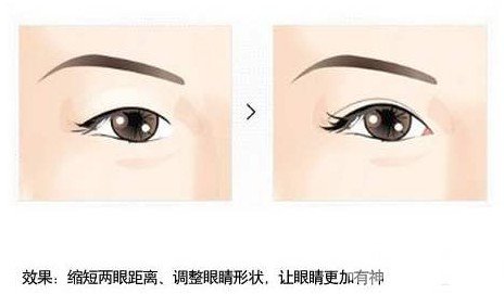 什么人适合开眼角