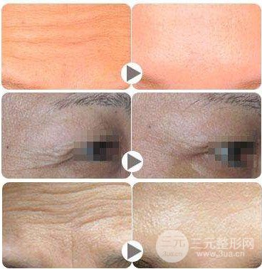 注射****注射瘦脸注意