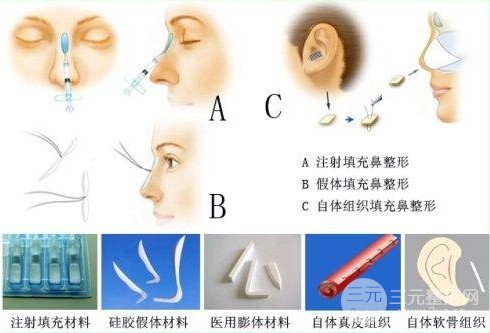 隆鼻假体材料有哪些
