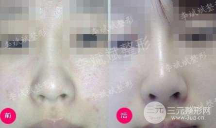 隆鼻假体材料有哪些