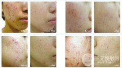 彩光美白嫩肤多少钱一次?能GET什么果?