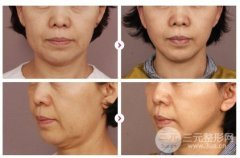 热玛吉紧肤除皱适合多大年龄的人做？价格是多少？