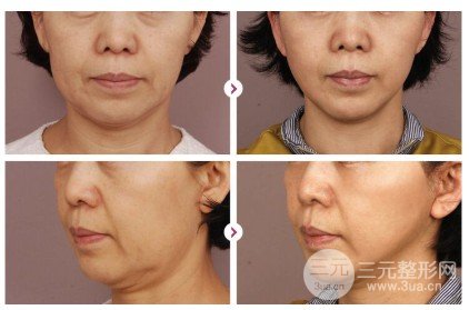 热玛吉紧肤除皱适合多大年龄的人做